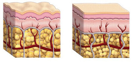 pele com e sem celulite - causas da celulite